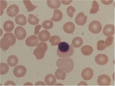 -Peripheral blood smear examination revealing normocytic normochromic ...