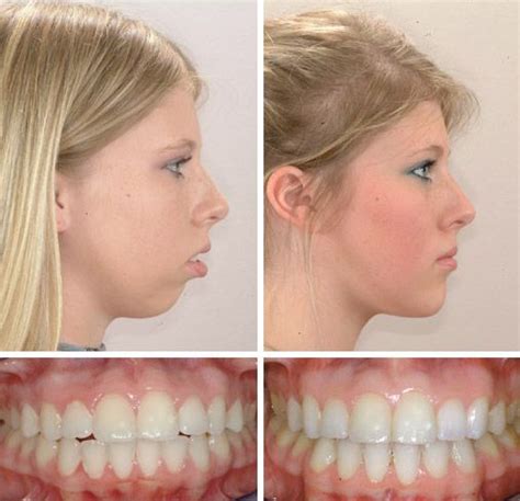 Before and After | Dental braces, Double jaw surgery, Face lift dentistry