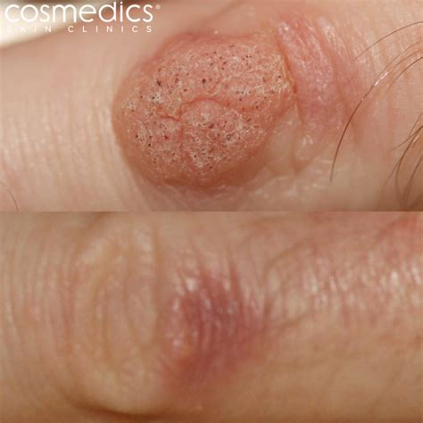 10 Common Places Warts Can Appear | London Mole Removal