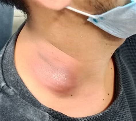 Very Swollen Lymph Nodes In Neck