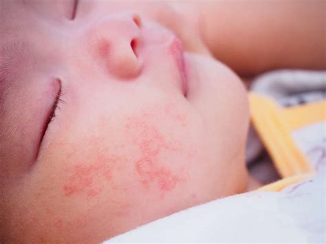 Food Allergy Rash On Face Allergy Rash Hives Food Allergy And Hives | Sexiz Pix