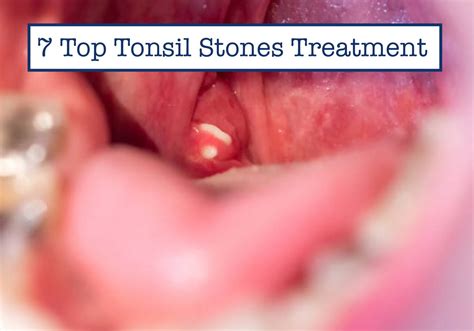 7 Top Tonsil Stones Treatment