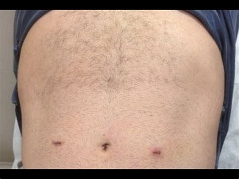 Inguinal Hernia Surgery Scar Pictures / INGUINAL HERNIA REPAIR ...