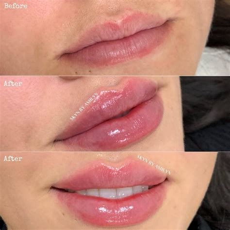 How Long Does Swelling Last After Lip Filler? - Public Health