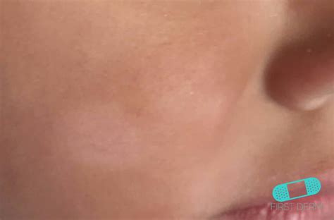 Why Do I Get Light Spots On My Face | Americanwarmoms.org