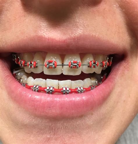 √ Awesome Braces Colors