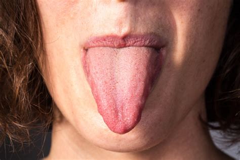 Burning Tongue: 9 Causes, One Life-Threatening » Scary Symptoms