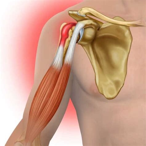 Arthroscopic or Open Biceps Tenodesis | Shoulder Surgeon | South Windsor, Enfield, Glastonbury CT