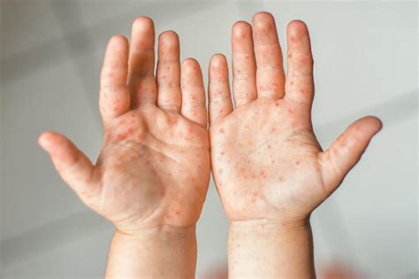Hand, Foot and Mouth Disease in Adults and Kids: Get the Facts - Riverchase Dermatology