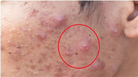 Fungal Acne On Body