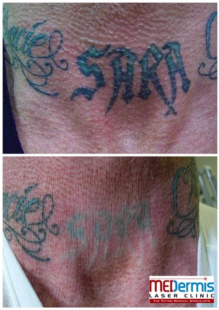 Undertaker Neck Tattoo Cover Up - Second Skin Tattoo