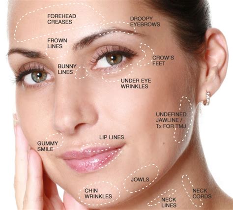 Aplicação de Botox Facial. Toxina Botulínica Preço. Valor