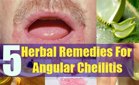 Effective 5 Herbal Remedies For Angular Cheilitis – Natural Home Remedies & Supplements