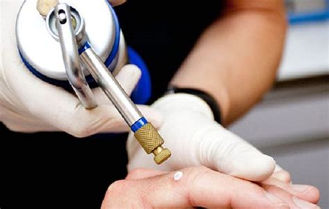 Cryosurgery Treatment | Skin Lesions | Dermatology Clinic Birmingham