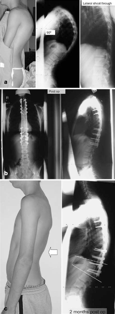 Scheuermann’s kyphosis: surgical management | Semantic Scholar