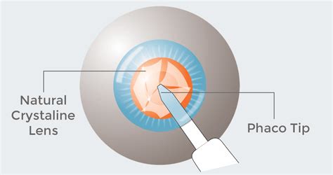 Refractive Lens Exchange (RLE) | Cataract Surgery | OPTIMAX Malaysia