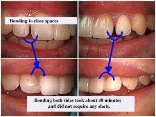 Bonding gaps between teeth with high end composite resins.