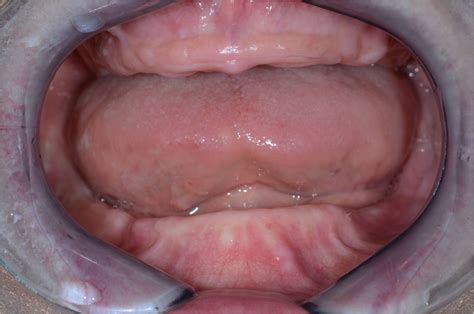 Fully edentulous maxilla - a "different" treatment approach | FOR.org