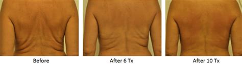 Body Contouring Before and After Images | Tampa Rejuvenation