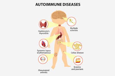 Gluten-Free and Healthy Living: Celiac-Disease and the Immune-System