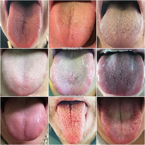 TCM: MONITORING TONGUE CHANGES — Kenton Sefcik, R.Ac