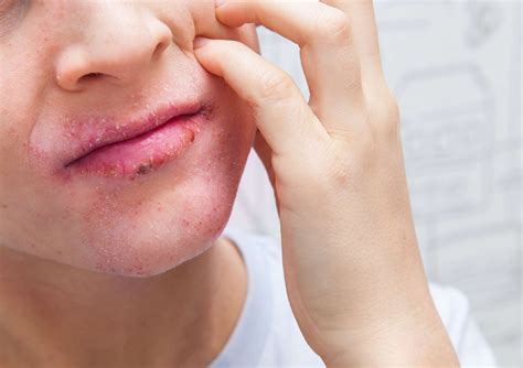 Eczema on Lips: Types, Symptoms, Treatment, and More