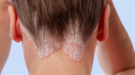 Scalp Psoriasis vs. Dandruff: Comparison and Treatment