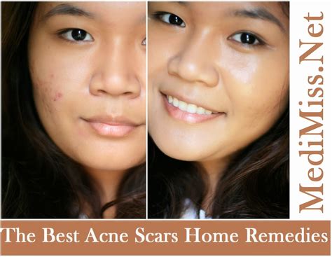 The Best Acne Scars Home Remedies - SkinnyZine