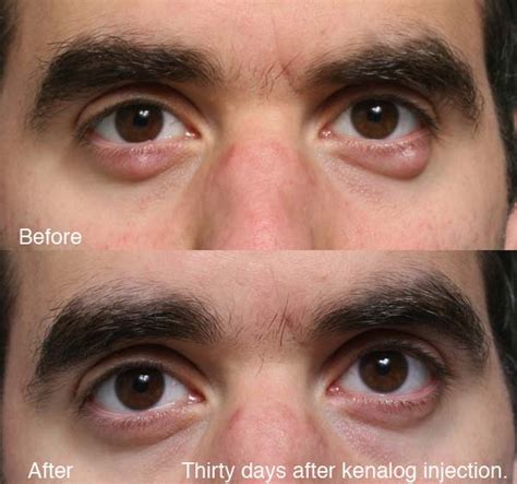 chalazion surgery recovery time - Captions Definition