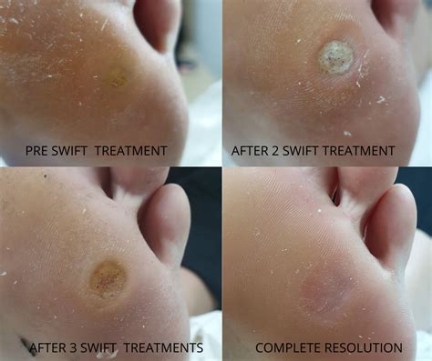 Why should I use Swift to treat my verruca? - West Berkshire Foot Clinic