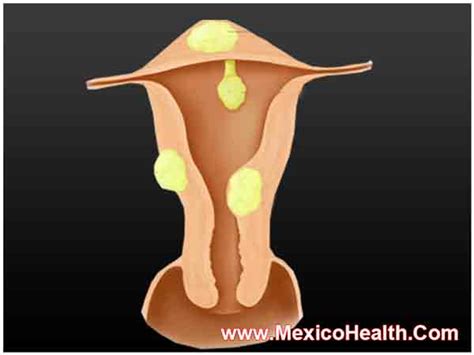 Fibroid Tumor Surgery Mexico - Mexico Health