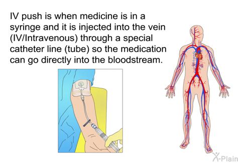 PatEdu.com : IV Push Infusion Therapy