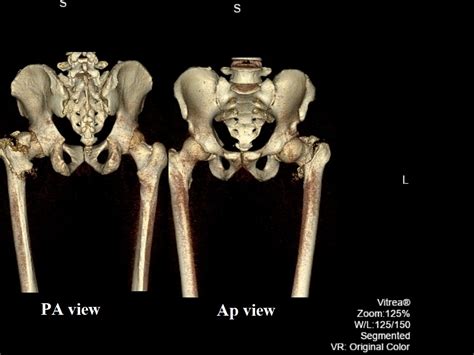 Hip fracture - wikidoc