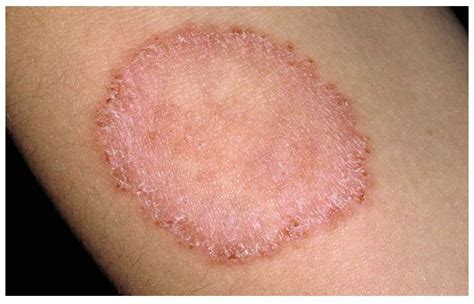 Fungal Rash Symptoms