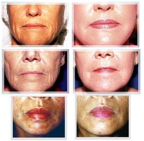 Glycolic Peels - Before and After | Peeling skin, Chemical peel, Acne scar removal