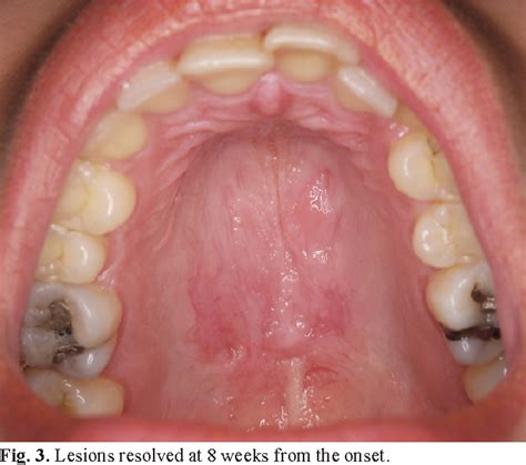 Figure 3 from Case report of necrotizing sialometaplasia. | Semantic ...