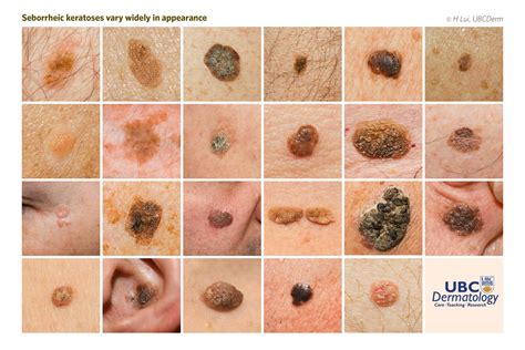 Seborrheic Keratosis Benign Skin Lesions Pictures - Jaleada Mapanfu