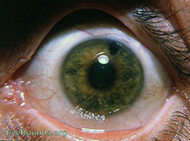 Siderosis. EyeRounds.org: Online Ophthalmic Atlas