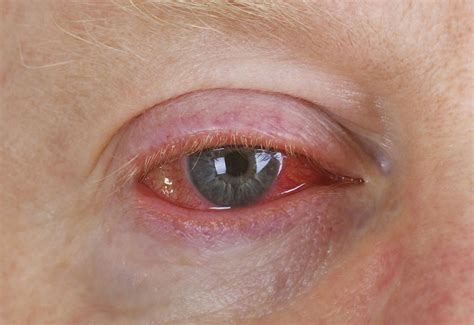 Conjunctivitis is spreading across the country. Here's what you need to know about the virus ...