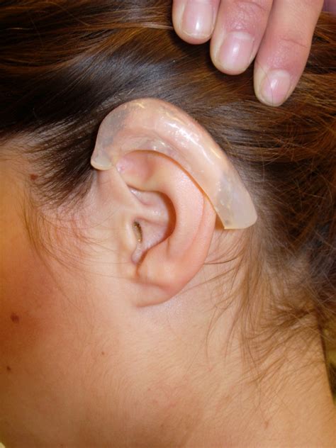 Keloid Ear