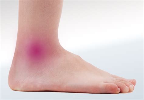 Ankle Pain On The Outside Of Foot Top Sellers | emergencydentistry.com