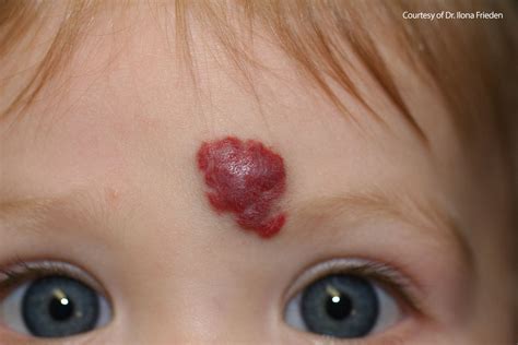 10 Common Bumps on the Face | Stay At Home Mum