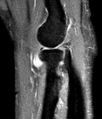 Posterior Interosseous Nerve Syndrome | Radsource