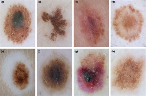 Abundance of the benign melanocytic universe: Dermoscopic–histopathological correlation in nevi ...