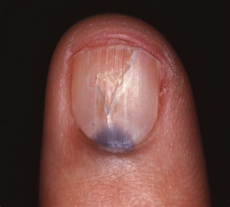 Lunula of Nails: What It Says About Your Health? – NailDesignCode