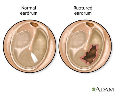 Perforated Eardrum Symptoms Causes Treatment Antibiot - vrogue.co