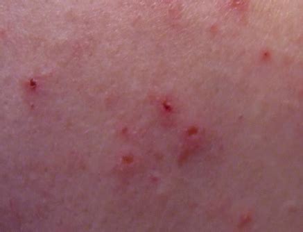 Gluten Rash - Symptoms, Causes, Treatment, Pictures