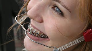 Laura Orthodontic Braces with High Pull Headgear and Milwaukee Brace ...