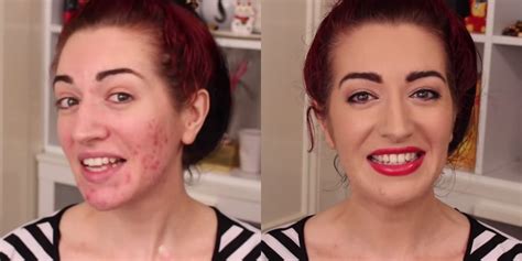 How To Hide Deep Acne Scars With Makeup | Saubhaya Makeup