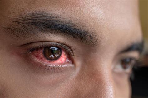 Do Red Eyes Mean Coronavirus Infection? - The Eye News
